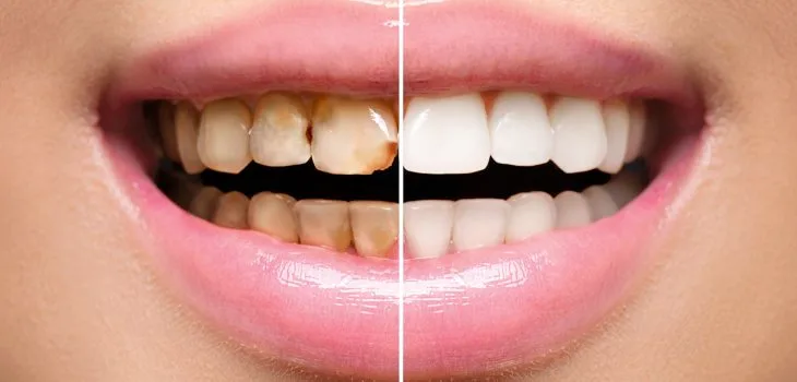 Rayyan Dental Center - Best Dental Care In Qatar Cosmetic Dentistry in Al Rayyan - Rayyan Dental Clinic